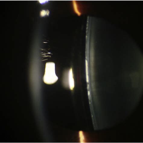 A Slit Lamp Photo Of The Right Eye On Postoperative Day After Icl