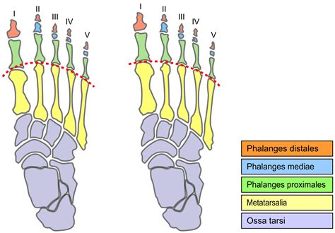 Mortons Neuroma Pressure Or Injury Associated With Shoes And Heels