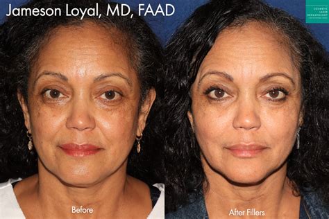 African American Skin Treatments San Diego Ca Clderm