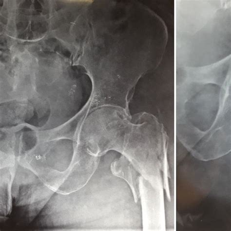 X-ray showing post operative AP and lateral view of PFN. | Download ...