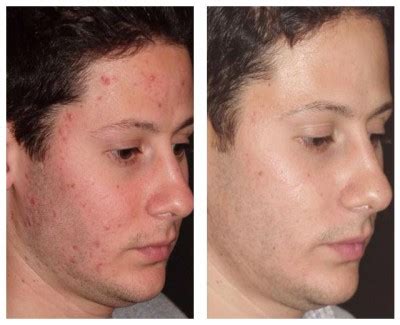 Laser Treatment For Acne And Acne Scarring Complexions Med Spa