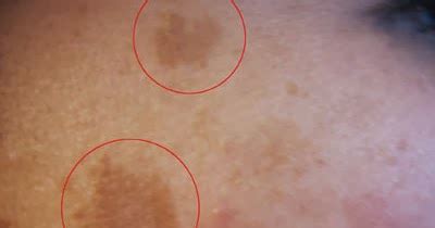 How To Get Rid Of Dark Marks Under Breast