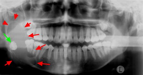 Ameloblastoma Histology Radiology Surgery And Treatment