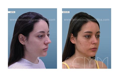 Rinoplastia · Caso 49 Cirugía Estética Madrid · Clínica Femm