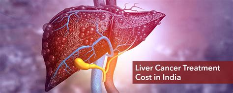 Liver Cancer Treatment Cost in India, Liver Cancer SurgeryCost in India