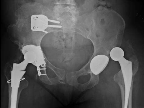 Anterior Hip Dislocation Following Revision Left Total Hip Download Scientific Diagram