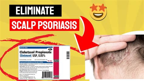 Say Goodbye To Scalp Psoriasis With Clobetasol Propionate A Game