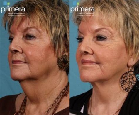 Chemical Peel Before And After Pictures Case 77 Orlando And Tampa Florida Primera Plastic Surgery