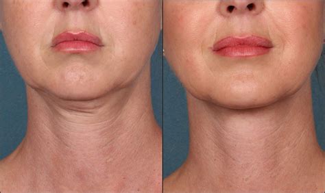 Tempsure Facial Neck Tightening Ottawa Medispa Orleans