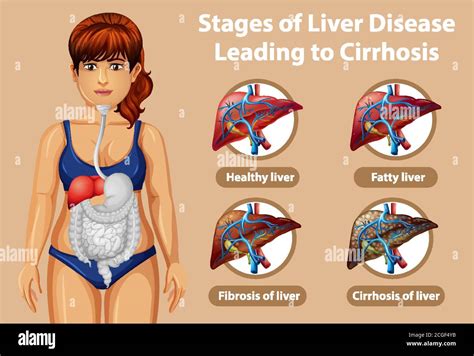 Etapas de la enfermedad hepática que conducen a la ilustración de la