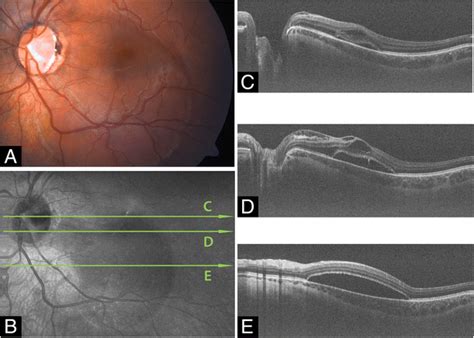 Optic Disc Pit Maculopathy Odp M On Mhz Oct Fundus Photograph Download Scientific Diagram