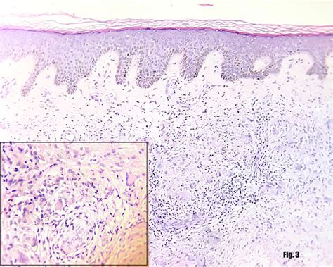 Showing The Granulomatous Inflammatory Infiltrate Throughout The Dermis Download Scientific