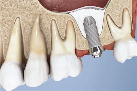 Il Rialzo Del Seno Mascellare Per Posizionare Gli Impianti Dentali