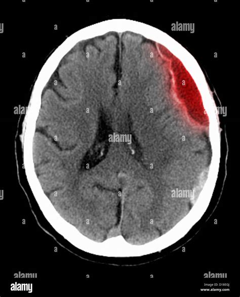 Ct Scan Images Of Brain - Image Of Cat