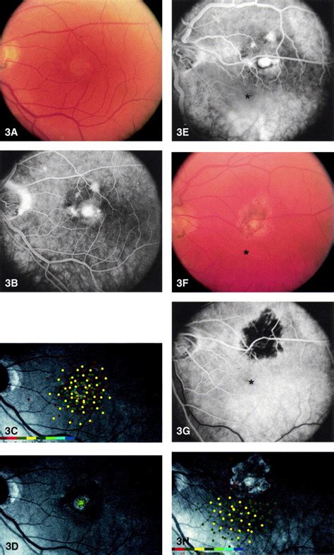 Patient Selection For Macular Translocation Surgery Using The Scanning