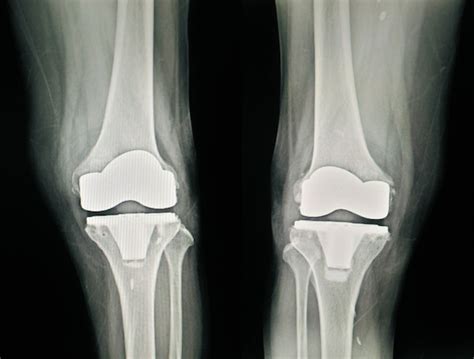 Premium Photo X Ray Post Operation Total Knee Arthroplastytkaview