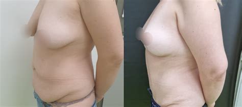 17 Inainte Si Dupa Before And After Abdominoplastie