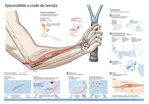 Dolor En Codo Epicondilitis Codo Del Tenista Causas Sintomas Y