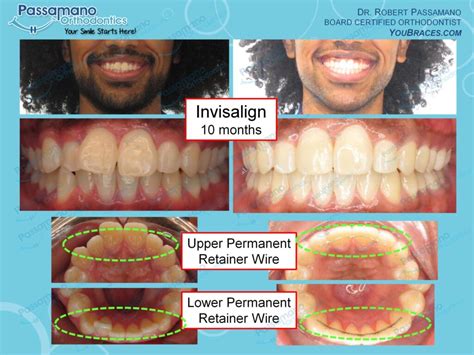 Front Two Teeth Crowding With Permanent Retainer Wires Passamano