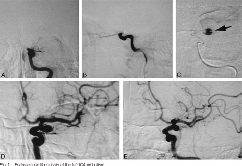 Figure 1 From Internal Carotid Artery Aneurysm Visualized During