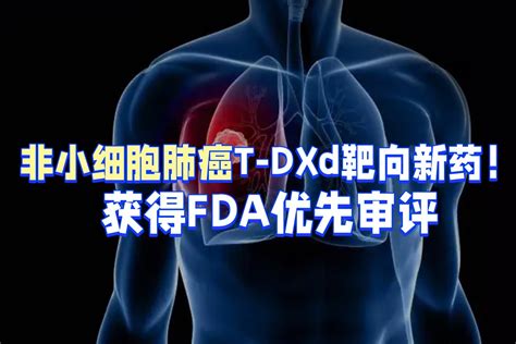 非小细胞肺癌T DXd靶向新药获得FDA优先审评 凤凰网视频 凤凰网