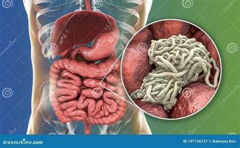 Vermes Parasit Rios No Intestino Humano Ilustra O Stock Ilustra O