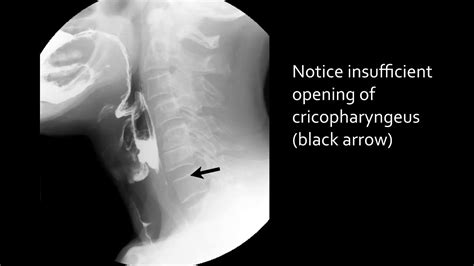 Normal Barium Swallow Anatomy