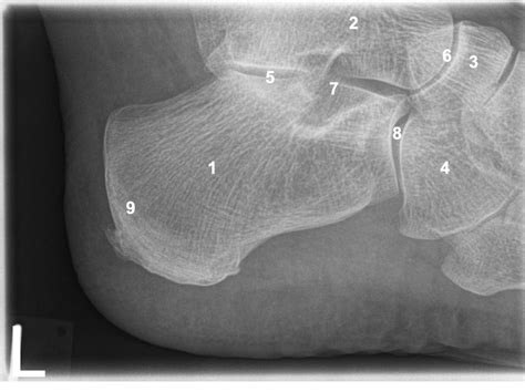 Calcaneus Lateral Diagram Quizlet