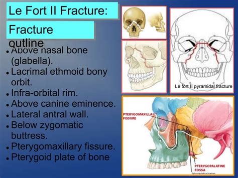 Mid Face Fracture Maxillary Fracture PPT