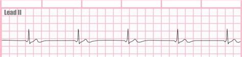 Ekg Dysrhythmias Flashcards Quizlet