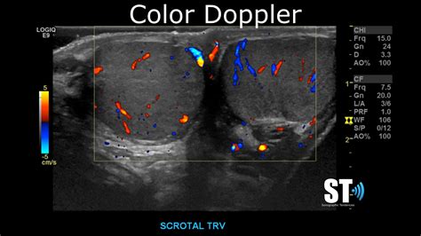 Testicularscrotal Doppler Protocol Sonographic Tendencies