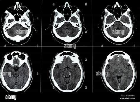 Tc Cerebral Que Muestra Cavernoma Del Tronco Encef Lico Anomal A