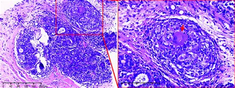 Idiopathic granulomatous mastitis was characterized as non-caseating... | Download Scientific ...