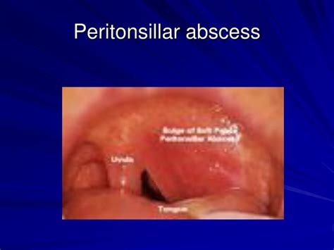 Peritonsillar Abscess Anatomy