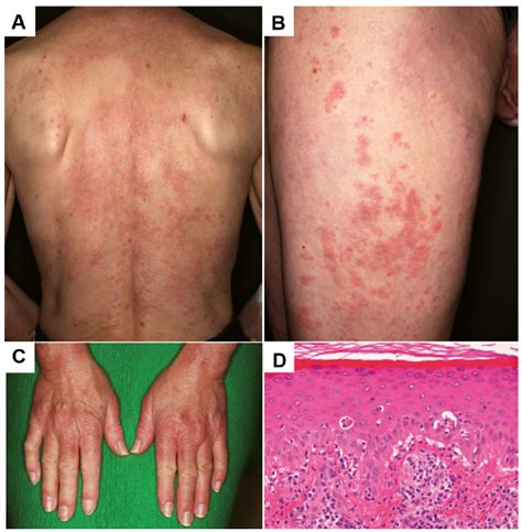 Myositis Skin Rash