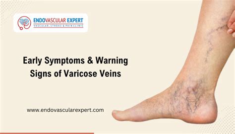 Early Symptoms and Warning Signs of Varicose Veins - Dr. Nikhil Bansal