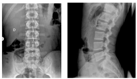 D T Radiograf A De Columna Vertebral