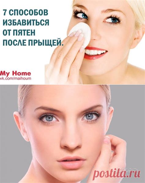 КАК ИЗБАВИТЬСЯ ОТ ПЯТЕН ПОСЛЕ ПРЫЩЕЙ | Красота - страшная сила. | Постила