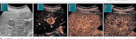 Figure 1 From Comments And Illustrations Of The WFUMB CEUS Liver