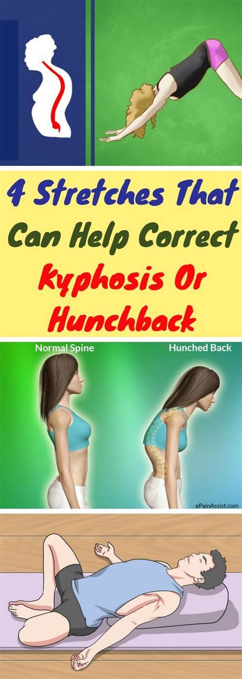 Stretches That Can Help Correct Kyphosis Or Hunchback With Images