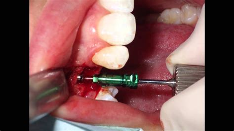 Dental Implant Step By Step After Bone Graft Upper Canine Youtube