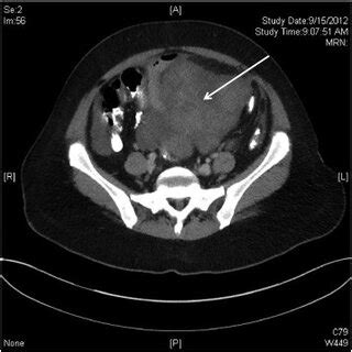 Preoperative Computed Tomography Scan Showing Pelvic Mass Arrow