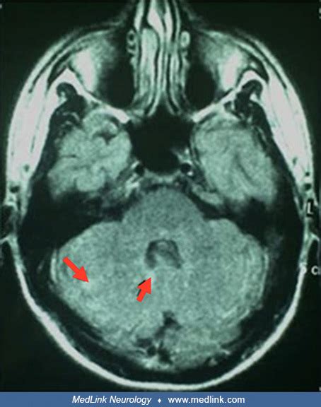 Susac Syndrome Medlink Neurology