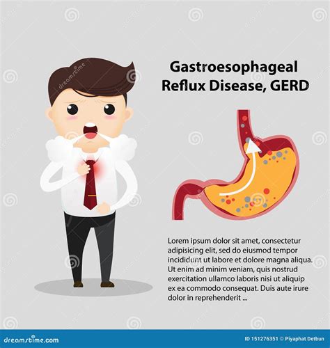 Enfermedad GERD Del Reflujo Gastroesofágico Ilustración del Vector