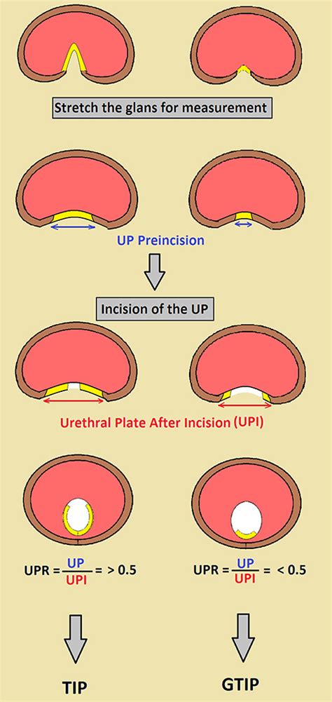 Frontiers When To Graft The Incised Plate During Tip Repair A Suggested Algorithm That May