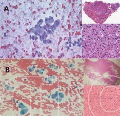 Hürthle Cell Lesion A Predominant Oncocytic Cells On Thyroid