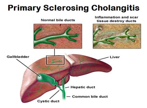 Primary Sclerosing Cholangitis Stepwards