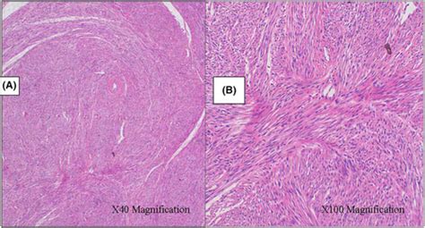 Unusual Case Of Broad Ligament Leiomyoma A Diagnostic And Surgical Challenge Lodhia 2022