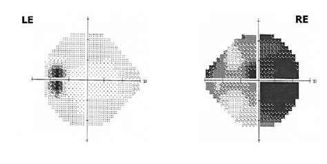 How To Test For Glaucoma? Diagnosis And Monitoring | Low Vision Aids