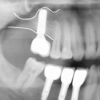 A 6 Months Follow Up OPG Radiograph Reveals A Good Level Of Bone